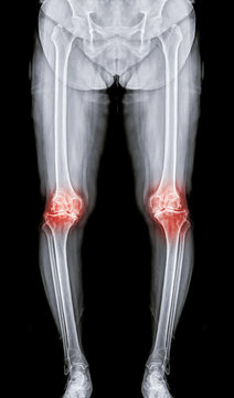 Scanogram is a Full-length standing AP radiograph of both lower extremities including the hip, knee, and ankle.