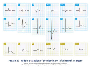 The proximal segment occlusion of the dominant left circumflex artery can lead to multiple myocardial infarction, including left ventricular lateral,posterior and inferior wall.