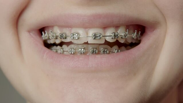 Orthodontic dental care concept. Woman with healthy teeth close up. Ceramic and metal brackets in the foreground on the teeth. Beautiful woman smile. Teeth straightening process with brackets arches.