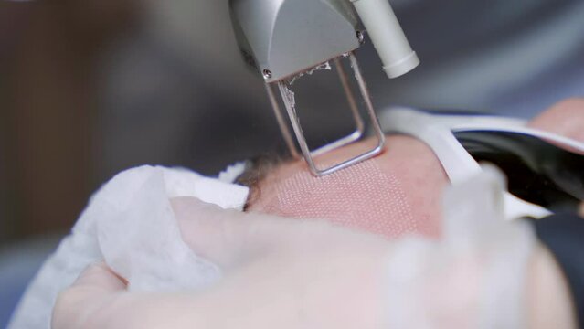 Beautician cosmetologist doing procedure fractional microneedle mesotherapy rejuvenation with laser technology. Hardware cosmetology in clinic salon for client.