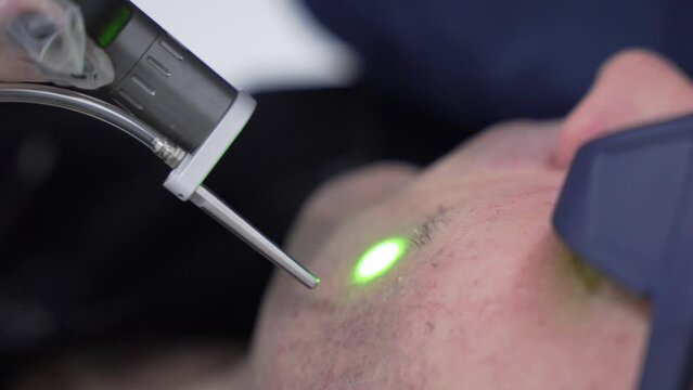 Man face epilation laser hair removal procedure treatment with alexandrite laser, unpainful procedure, beauty concept,