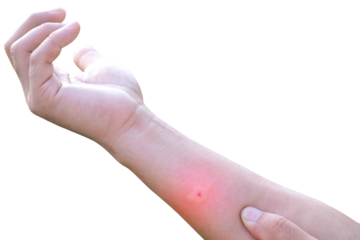 Swollen arms due to mosquito bites isolate on transparent background , poisonous animals, plague in the rainy season, PNG File