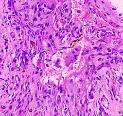 Oral submucous fibrosis (OSF), abnormal collagen deposition. precancerous disorder and transforms. Photomicrograph,