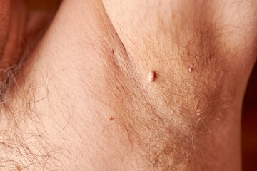 Fototapeta premium Large papilloma under the armpit of a man. Skin disease. Skin care.