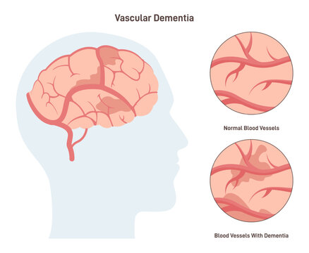 Vascular dementia. Common type of dementia caused by reduced blood