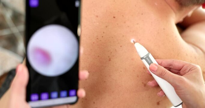 Method of dermatoscopy of skin formations and moles