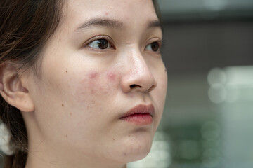 Asian young with pimple, acne, scar on skin, facial problem.