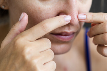 Young woman with a problem dry skin and with big pores on her nose.