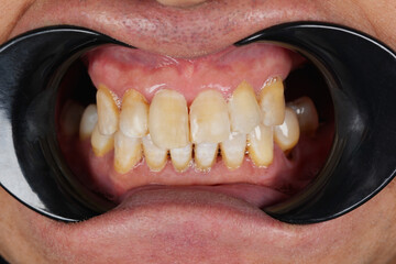 Smiling mouth of a man with crooked ugly yellow teeth close-up