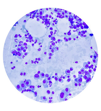 Microscopic view of bone marrow slide showing Multiple myeloma, also known as myeloma, is a type of bone marrow cancer.