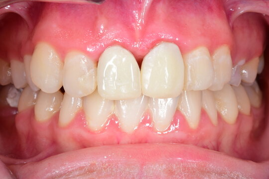 Fixed prosthetic crowns in central incisors. Frontal view of maxillary arch incisor and canine teeth, gum inflammatory. Cheeks and lips retracted with cheek retractor