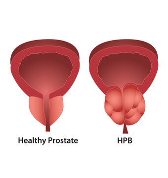 Prostate - Pr&oacute;stata