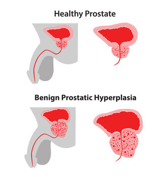 Prostate - Pr&oacute;stata 