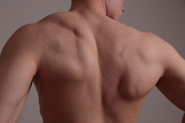 Anabolic steroids and skin problems. Sport man with pimples back acne