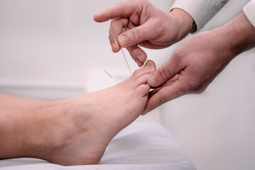 close-up of hands placing acupuncture needles in patient's foot