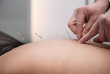 acupuncture needles treatment on patient - obrazy, fototapety, plakaty