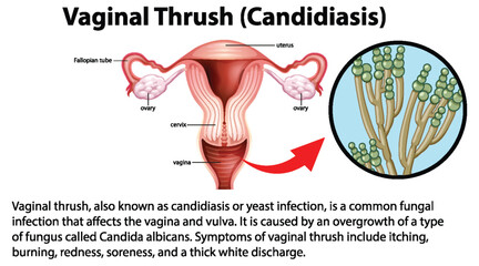 Obraz premium Vaginal Thrush (Candidiasis) infographic with explanation