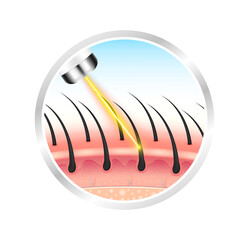 Skin layers anatomy with hairs and yellow laser light hair removal. Unwanted out make skin smooth. Label silver circle used for beauty advertisements. Medical science concept. File PNG 3D.