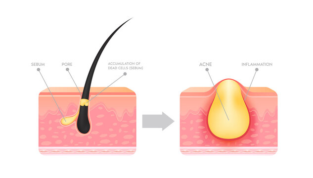 Formation of skin acne or pimple. Accumulation of dead cells and inflammation associated with pimples. The sebum in the clogged pore promotes the growth of a certain bacteria. File PNG 3D.