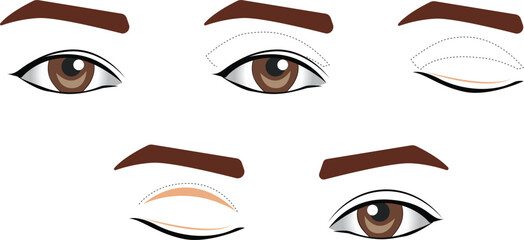 Blepharoplasty of the upper and lower eyelids