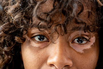 Portrait of young Brazilian woman with Vitiligo on face and eyes contour, close up of details of...