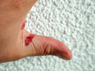 work accident-a human hand injured after a work accident, hand injuries,