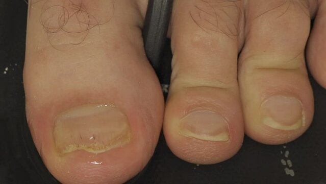 A man is dripping drops on toenails infected with fungus in close-up shot.