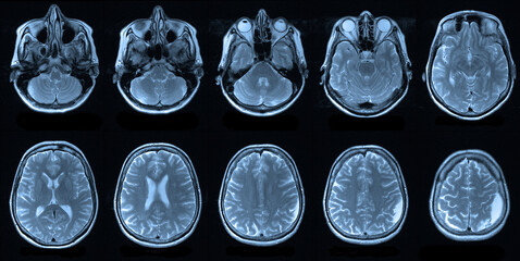 x image of brain. Magnetic resonance imaging of the human head, MRI - obrazy, fototapety, plakaty