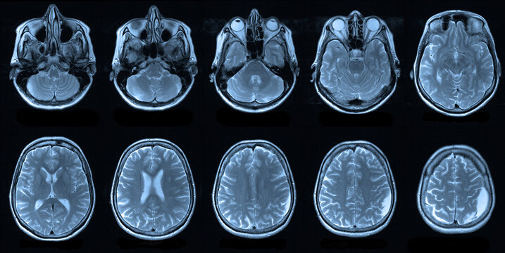 x image of brain. Magnetic resonance imaging of the human head, MRI
