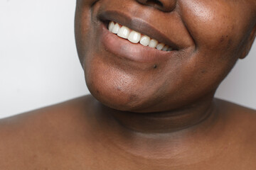 Fototapeta premium Brown skin with dark spots, hyperpigmentation on brown skin, african american woman with skin blemishes, imperfect skin 