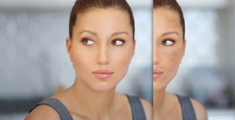 Dark spots, freckles,hyperpigmentation(melasma or chloasma),concept - skin lightening, skin...