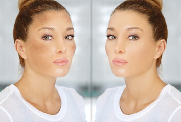 Dark spots, freckles,hyperpigmentation(melasma or chloasma),concept - skin lightening, skin whitening, fruit acids,AHA, Skin Brightening