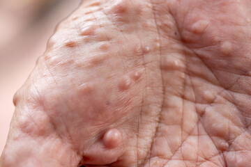Background of human skin with Neurofibromatosis are a group of genetic disorders that cause tumors...