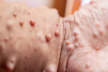 Background of human skin with Neurofibromatosis are a group of genetic disorders that cause tumors...