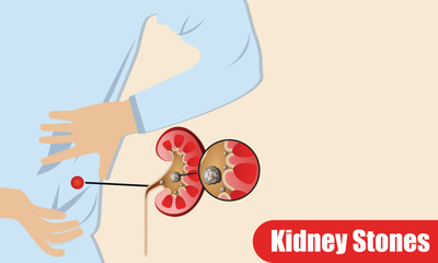 kidney stones disease in flat design
