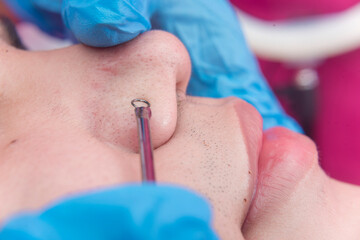 An esthetician uses a comedone extractor to remove blackheads on the nose of a male patient....