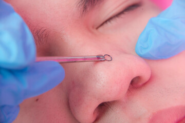An esthetician uses a comedone extractor to remove blackheads on the nose of a male patient. Closeup shot of a facial procedure and treatment at a dermatology or aesthetic clinic.