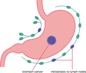 リンパ節に移転した胃がんのイラスト／Illustration of stomach cancer that has moved to the lymph nodes - obrazy, fototapety, plakaty