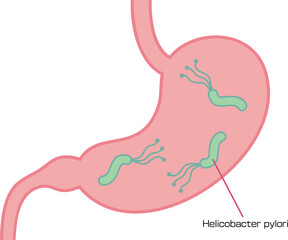 ピロリ菌に侵された胃のイラスト／Illustration of stomach affected by Helicobacter pylori