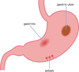 胃炎、胃潰瘍、ポリープを表したイラスト／Illustration showing gastritis, stomach ulcer and polyp - obrazy, fototapety, plakaty