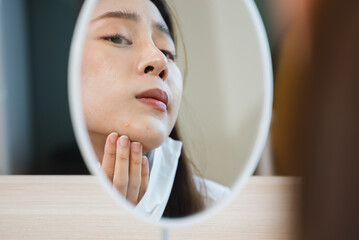 female have an acne problem because wearing face mask.