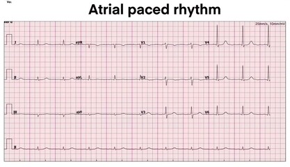 Electrocardiogram show atrial paced rhythm. Cardiac Pacemaker. Heart beat. CPR. ECG. EKG. Vital sign. Life support. Medical healthcare symbol.