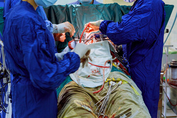 As part of heart operations due to coronary heart disease that are being performed in operating...