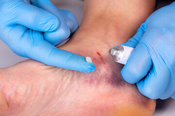 Doctors hands in gloves smear medicinal ointment to bruise on the patients leg