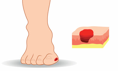 Diabetic foot illustration. Ulcer in the toe and an isolated skin layers  with the ulcer - obrazy, fototapety, plakaty
