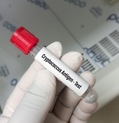 CSF sample for Cryptococcus Antigen test to diagnosis of cryptococcal pneumonia or meningitis or...