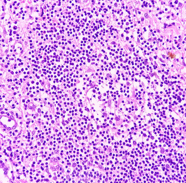 Perianal Abscess Tissue: Foreign Body Granuloma, Microscopically Show Granuloma, Cluster Of Epithelioid Cells, Lymphocytes, Histiocytes Foreign Body Giant Cells And Plasma Cells. No Malignancy.