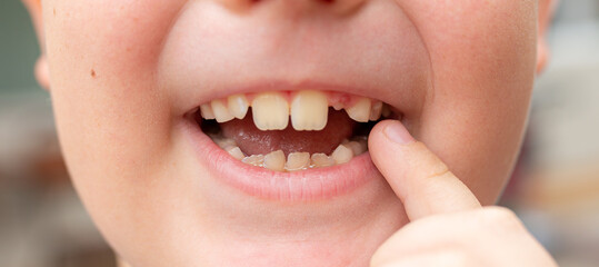 Close-up of a boy showing a fallen tooth. Loss of teeth, concept of dental problems
