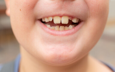Close-up of a boy showing a fallen tooth. Loss of teeth, concept of dental problems