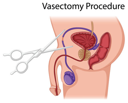 Diagram Showing Vasectomy Procedure